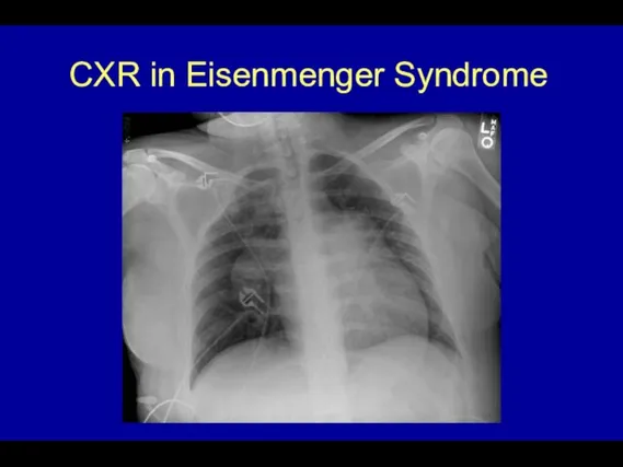 CXR in Eisenmenger Syndrome