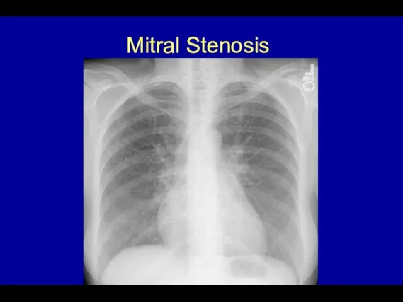 Mitral Stenosis