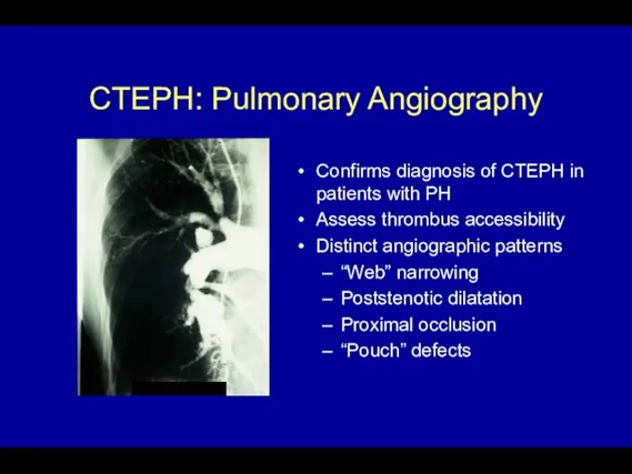 CTEPH: Pulmonary Angiography Confirms diagnosis of CTEPH in patients with PH