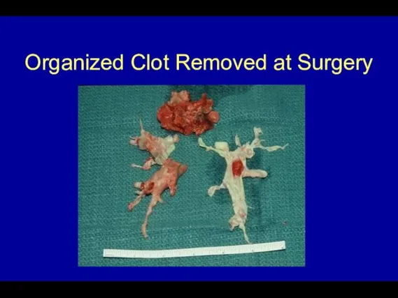 Organized Clot Removed at Surgery