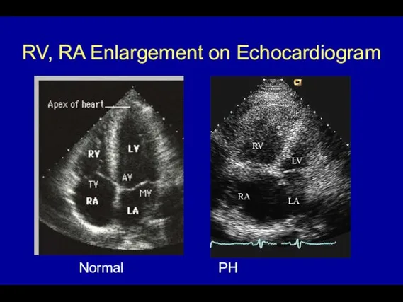 RV, RA Enlargement on Echocardiogram RV LV RA LA Normal PH