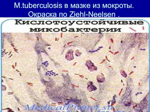 M.tuberculosis в мазке из мокроты. Окраска по Ziehl-Neelsen .