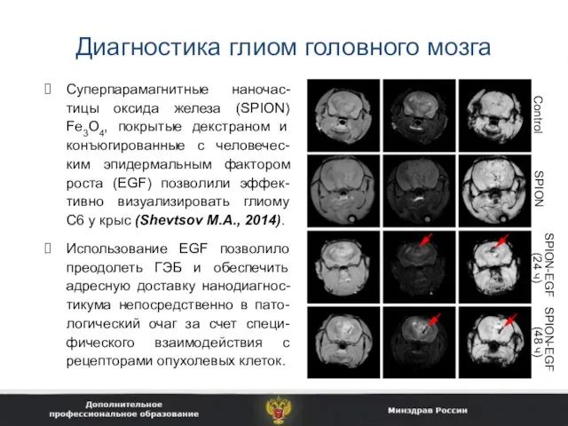 Диагностика глиом головного мозга Суперпарамагнитные наночас-тицы оксида железа (SPION) Fe3O4, покрытые