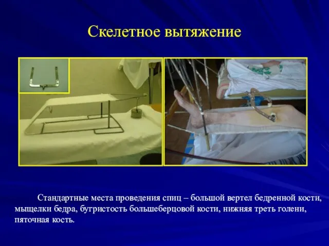 Скелетное вытяжение Стандартные места проведения спиц – большой вертел бедренной кости,