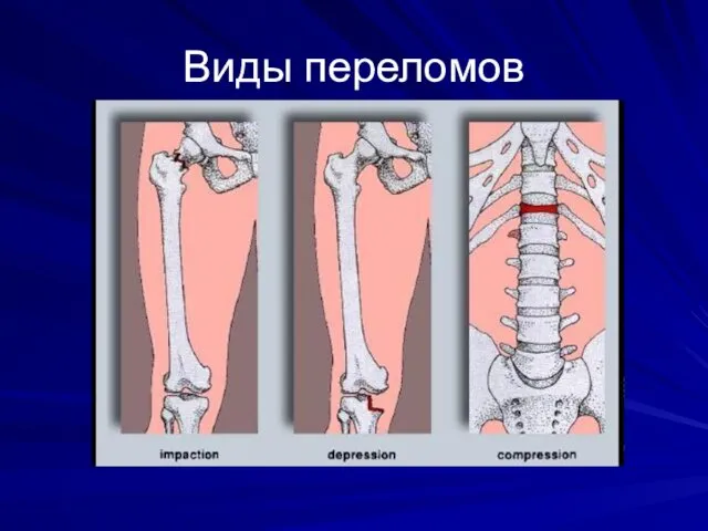 Виды переломов