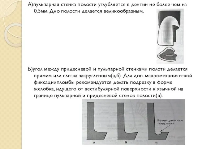 А)пульпарная стенка полости углубляется в дентин не более чем на 0,5мм.