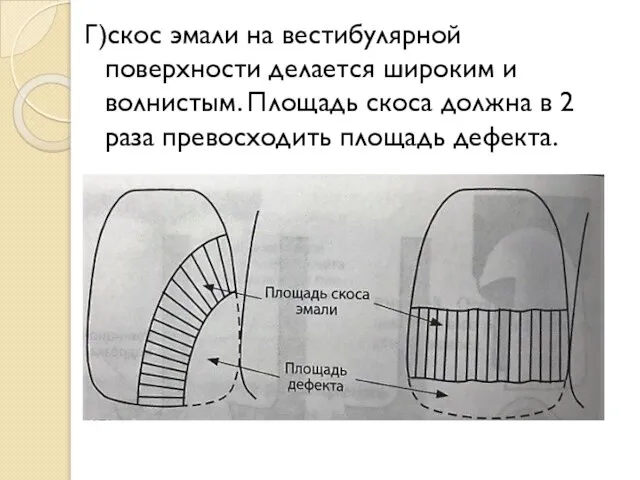 Г)скос эмали на вестибулярной поверхности делается широким и волнистым. Площадь скоса