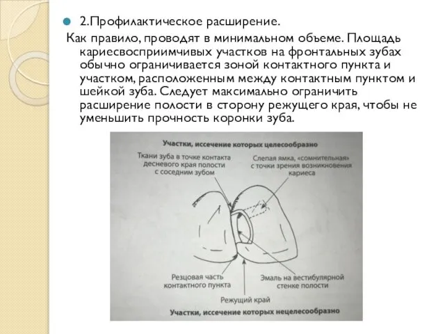 2.Профилактическое расширение. Как правило, проводят в минимальном объеме. Площадь кариесвосприимчивых участков