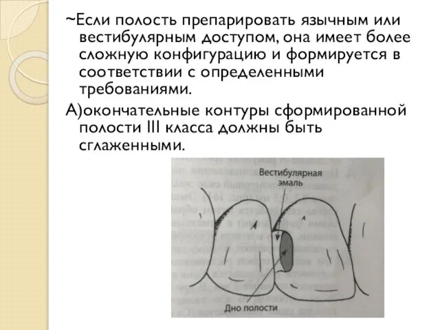 ~Если полость препарировать язычным или вестибулярным доступом, она имеет более сложную