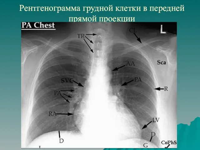 Рентгенограмма грудной клетки в передней прямой проекции