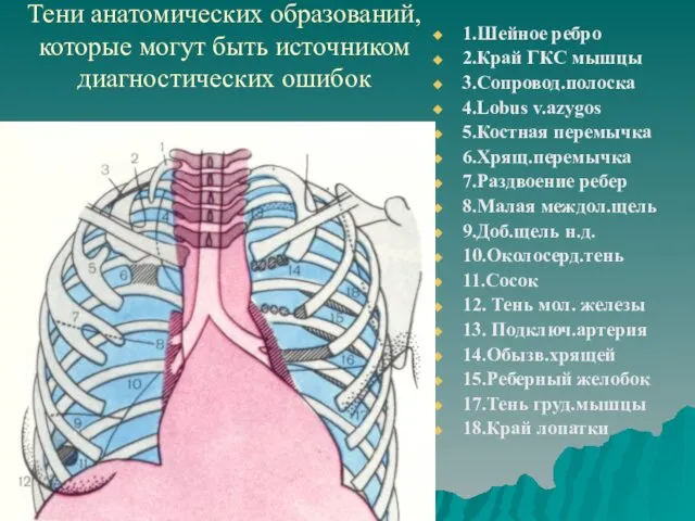 Тени анатомических образований, которые могут быть источником диагностических ошибок 1.Шейное ребро