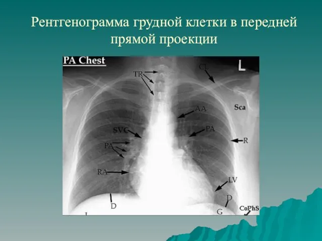 Рентгенограмма грудной клетки в передней прямой проекции