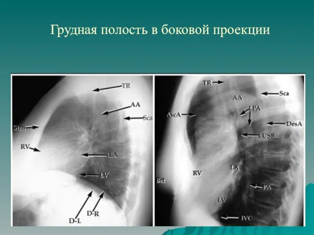 Грудная полость в боковой проекции