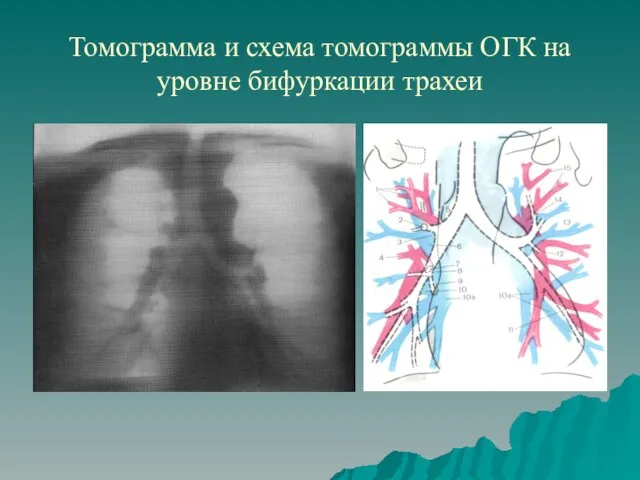 Томограмма и схема томограммы ОГК на уровне бифуркации трахеи