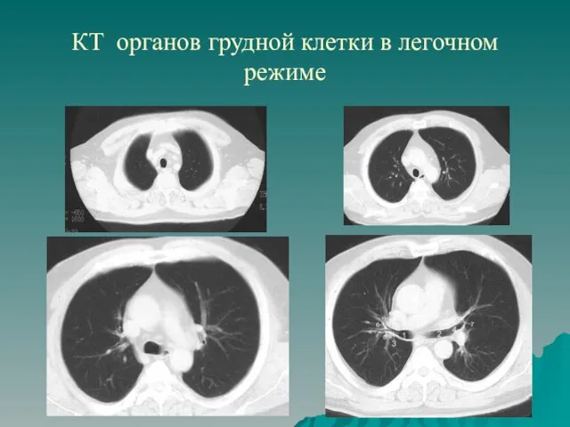 КТ органов грудной клетки в легочном режиме