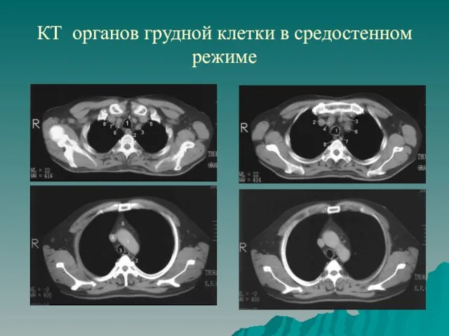 КТ органов грудной клетки в средостенном режиме