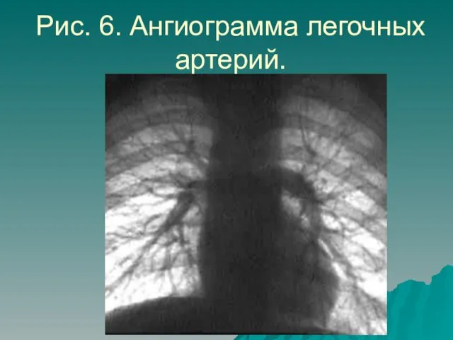 Рис. 6. Ангиограмма легочных артерий.