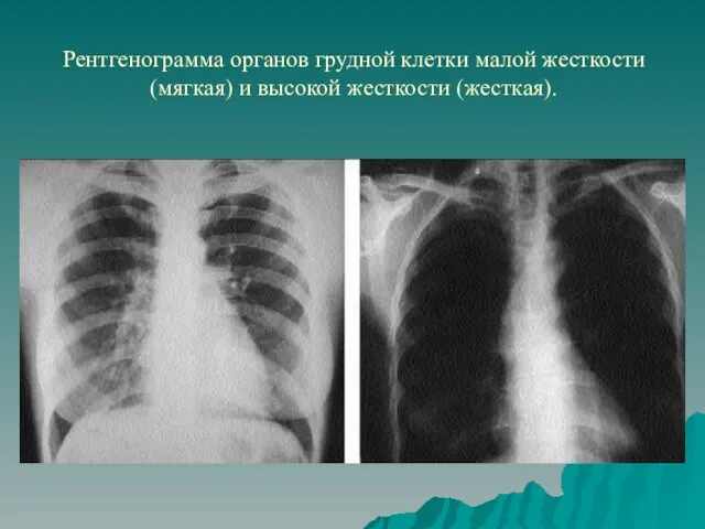 Рентгенограмма органов грудной клетки малой жесткости (мягкая) и высокой жесткости (жесткая).