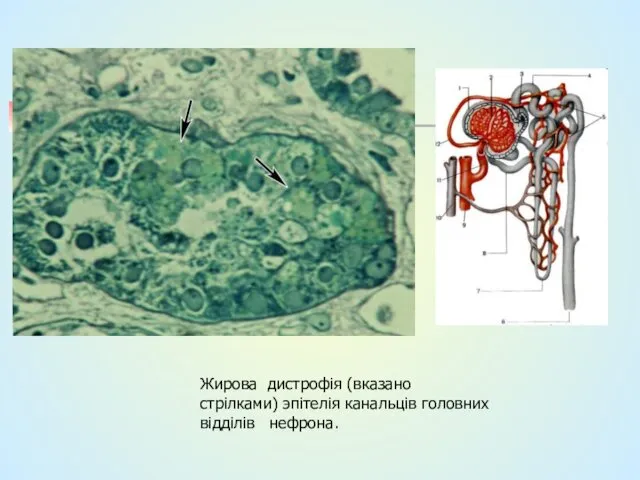 Жирова дистрофія (вказано стрілками) эпітелія канальців головних відділів нефрона.