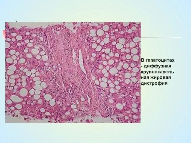 В гепатоцитах - диффузная крупнокапельная жировая дистрофия