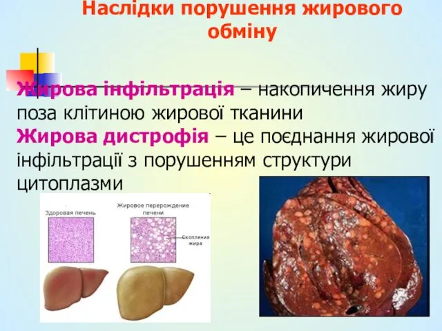 Наслідки порушення жирового обміну Жирова інфільтрація – накопичення жиру поза клітиною