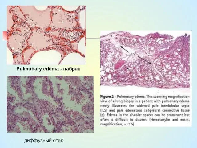 Pulmonary edema - набряк диффузный отек