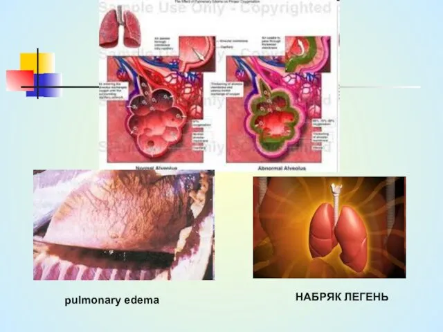 НАБРЯК ЛЕГЕНЬ pulmonary edema