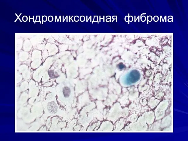 Хондромиксоидная фиброма