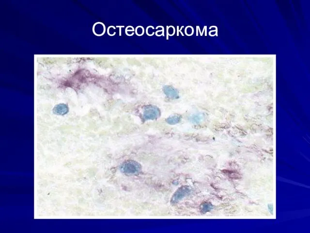 Остеосаркома