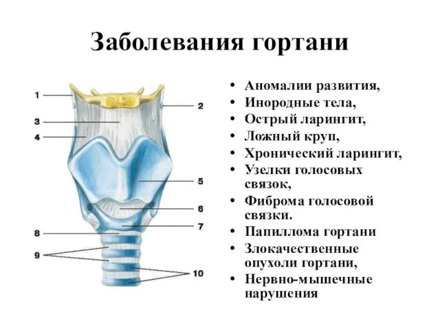 Заболевания гортани Аномалии развития, Инородные тела, Острый ларингит, Ложный круп, Хронический