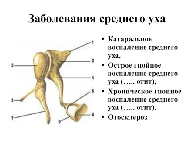 Заболевания среднего уха Катаральное воспаление среднего уха, Острое гнойное воспаление среднего