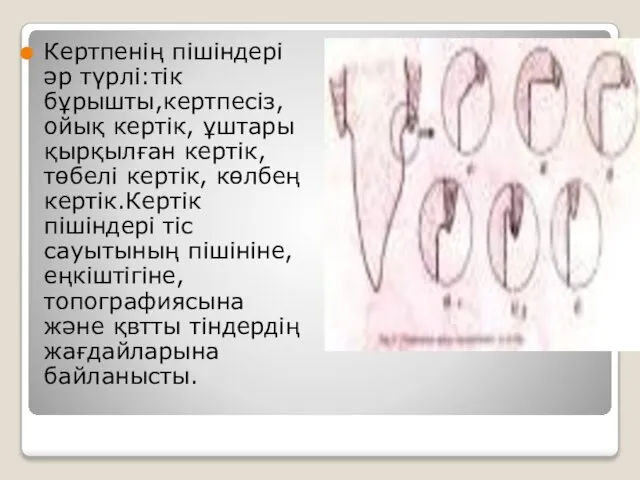 Кертпенің пішіндері әр түрлі:тік бұрышты,кертпесіз, ойық кертік, ұштары қырқылған кертік,төбелі кертік,