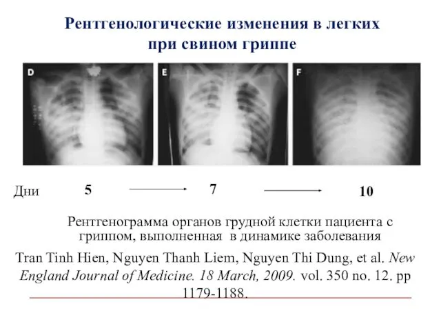 Рентгенологические изменения в легких при свином гриппе Рентгенограмма органов грудной клетки