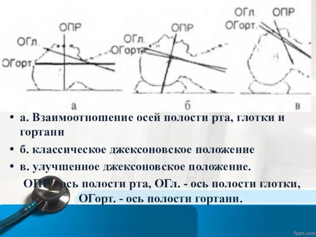 а. Взаимоотношение осей полости рта, глотки и гортани б. классическое джексоновское