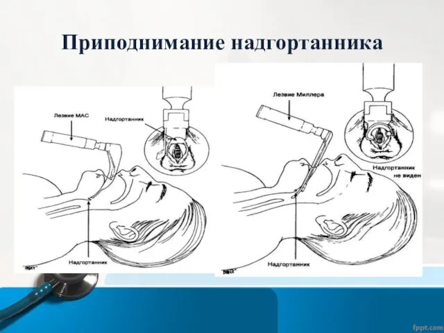 Приподнимание надгортанника