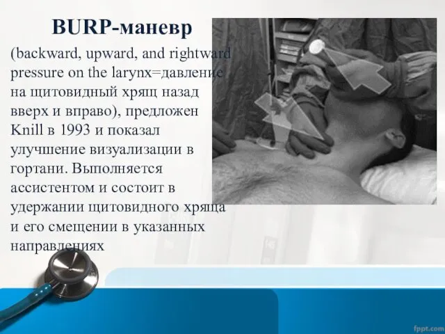 BURP-маневр (backward, upward, and rightward pressure on the larynx=давление на щитовидный