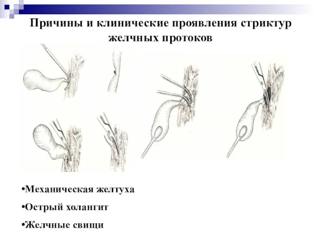 Причины и клинические проявления стриктур желчных протоков Механическая желтуха Острый холангит Желчные свищи