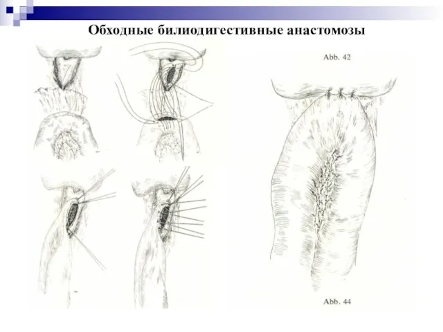 Обходные билиодигестивные анастомозы