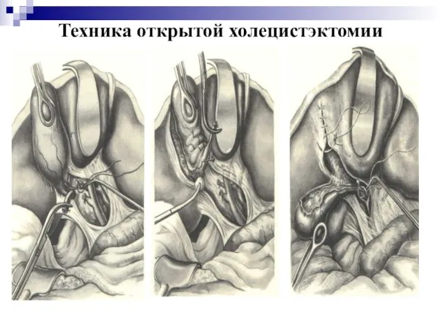 Техника открытой холецистэктомии