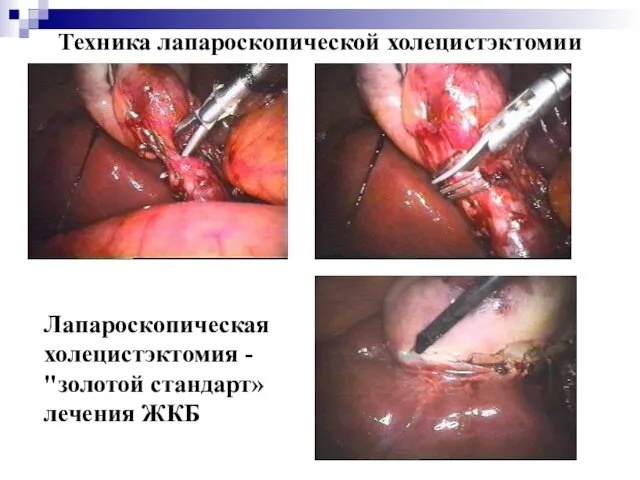 Техника лапароскопической холецистэктомии Лапароскопическая холецистэктомия - "золотой стандарт» лечения ЖКБ