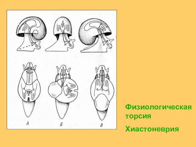 Физиологическая торсия Хиастоневрия