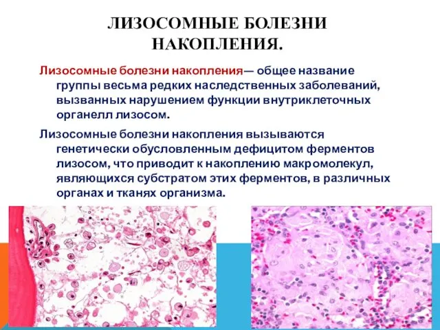 ЛИЗОСОМНЫЕ БОЛЕЗНИ НАКОПЛЕНИЯ. Лизосомные болезни накопления— общее название группы весьма редких