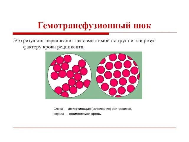 Гемотрансфузионный шок Это результат переливания несовместимой по группе или резус фактору крови реципиента.