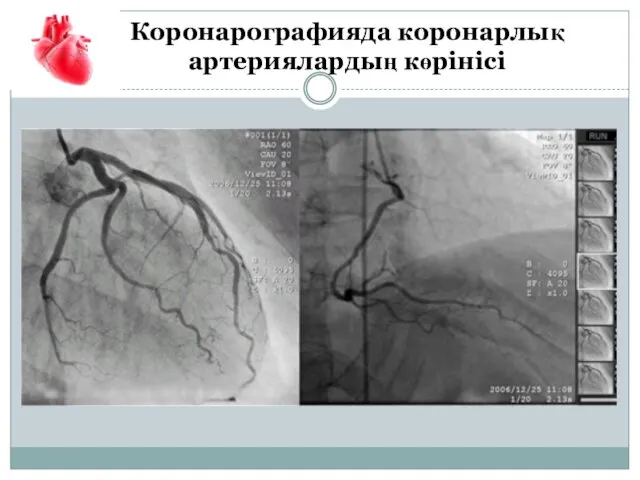 Коронарографияда коронарлық артериялардың көрінісі