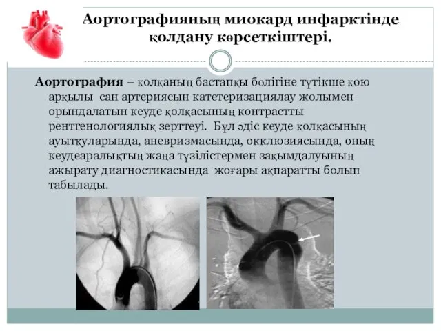 Аортографияның миокард инфарктінде қолдану көрсеткіштері. Аортография – қолқаның бастапқы бөлігіне түтікше