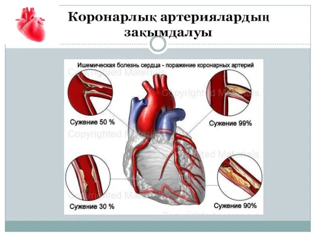 Коронарлық артериялардың зақымдалуы