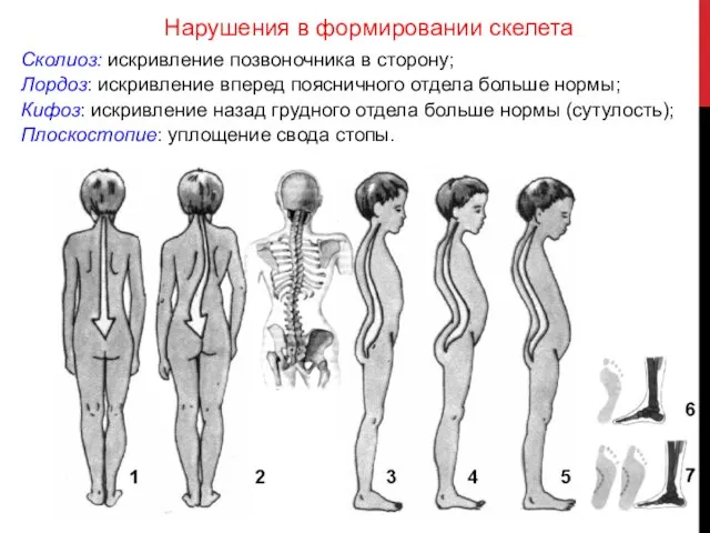 Сколиоз: искривление позвоночника в сторону; Лордоз: искривление вперед поясничного отдела больше