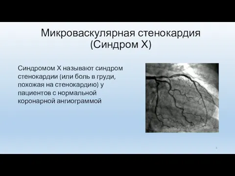 Микроваскулярная стенокардия (Синдром Х) Синдромом Х называют синдром стенокардии (или боль