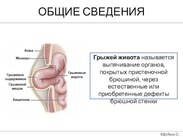 ОБЩИЕ СВЕДЕНИЯ ©Добыш С.А. Грыжей живота называется выпячивание органов, покрытых пристеночной