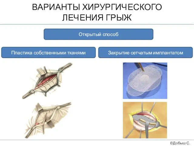 ВАРИАНТЫ ХИРУРГИЧЕСКОГО ЛЕЧЕНИЯ ГРЫЖ ©Добыш С.А. Открытый способ Пластика собственными тканями Закрытие сетчатым имплантатом